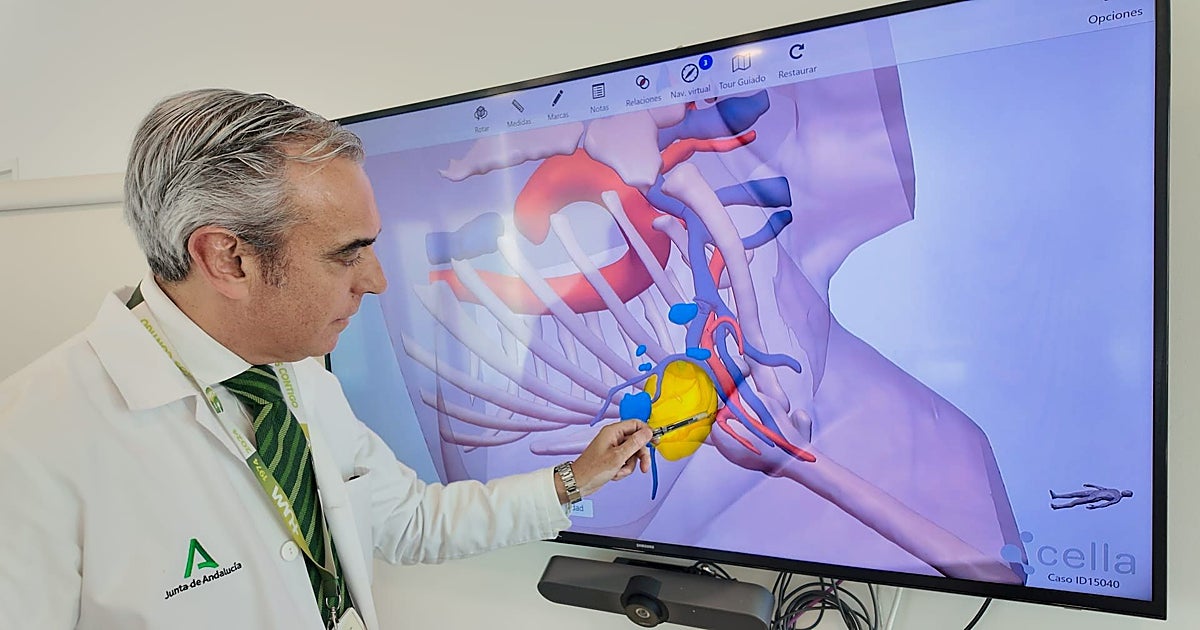 El Hospital Virgen Macarena de Sevilla recrea imágenes en 3D de tumores a través de la IA