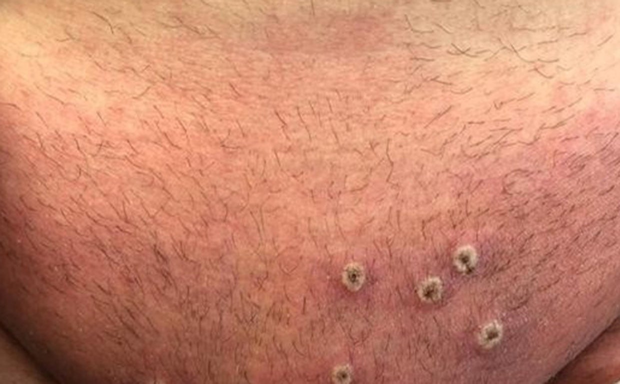 Pústulas provocadas por la viruela del mono - ABC // Vídeo: El pasado domingo, la OMS declaró la viruela del mono emergencia sanitaria internacional