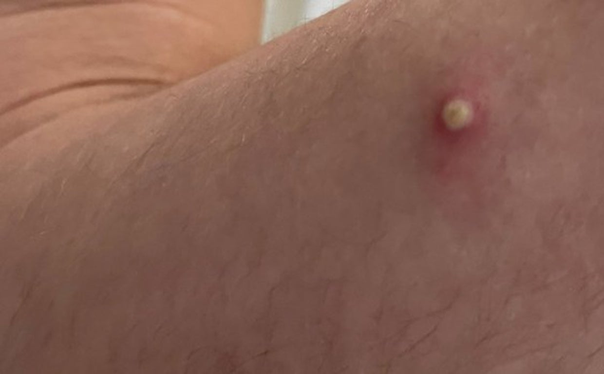 Síntomas de la viruela del mono