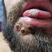 Imagen - Las lesiones de Mario en la lengua no le dejaron comer durante días. La gran inflamación de sus heridas en la cara le provocó una parálisis facial