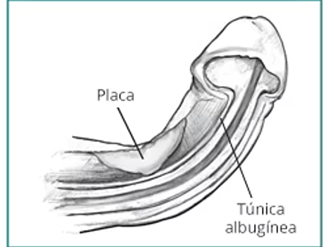 Dibujo de un pene con la enfermedad de Peyrone proporcionada por el Instituto Nacional de Salud, dependiente del Departamento de Salud y Servicios Humanos de Estados Unidos