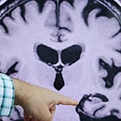 El alzhéimer podría prevenirse con un alimento para la musculación