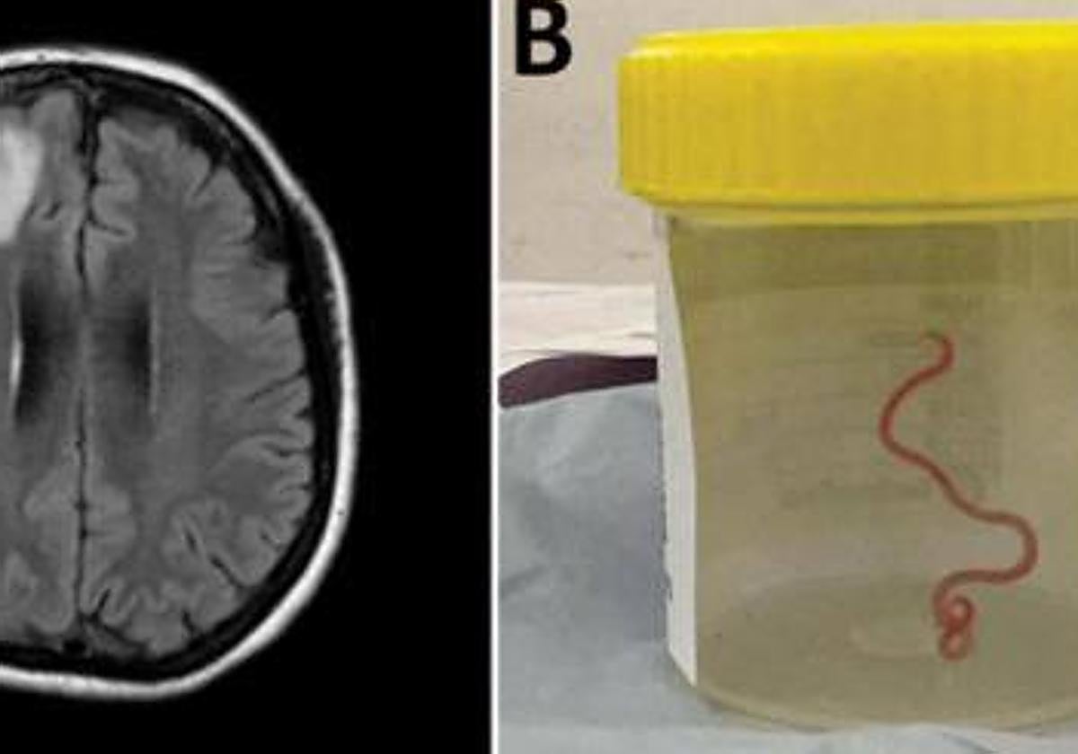 Imagen de la lombriz extraída a la paciente