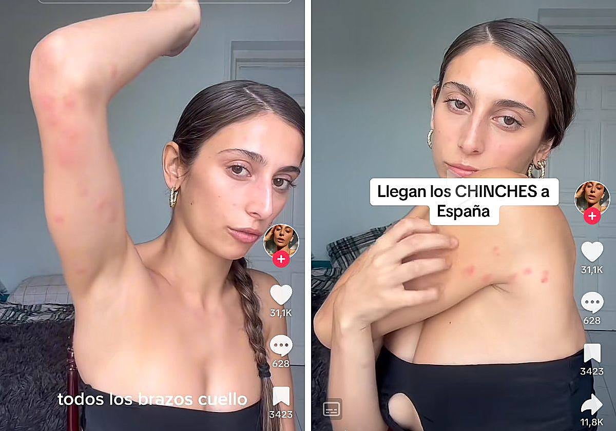 María Pérez, bailarina de Chanel, muestra las picaduras en TikTok