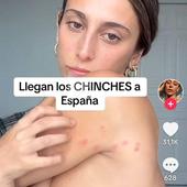 La plaga de chinches acribilla a una bailarina de Chanel en Zaragoza