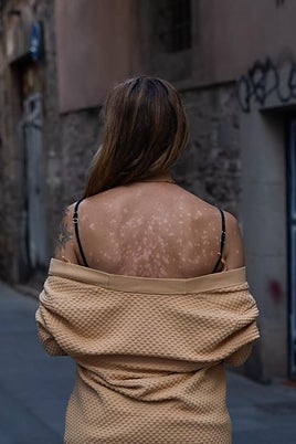 Trini Barrera lleva dos décadas escondiendo la piel por su psoriasis