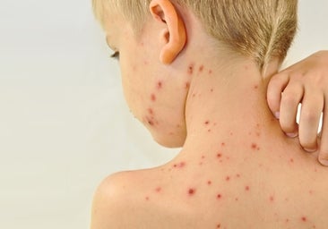 La OMS alerta de casos de sarampión entre personas mal vacunadas en Europa