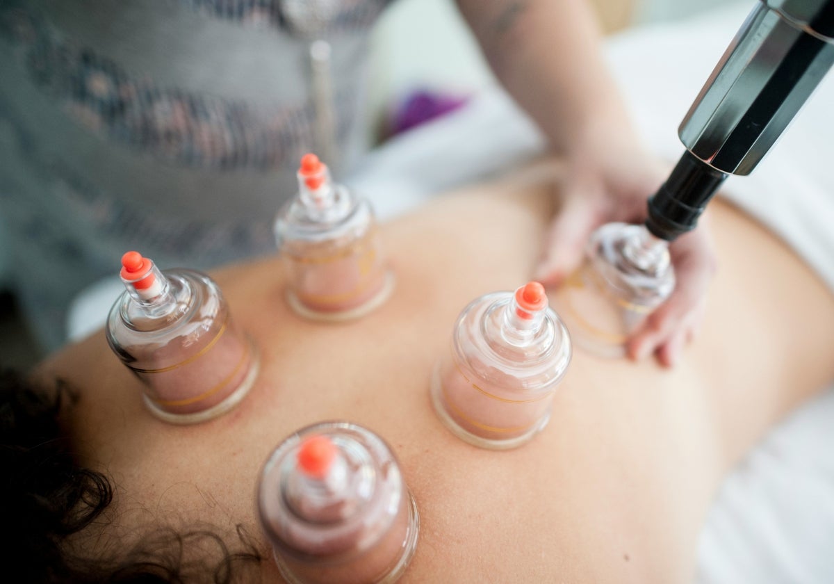 La técnica de 'cupping' o terapia con ventosas