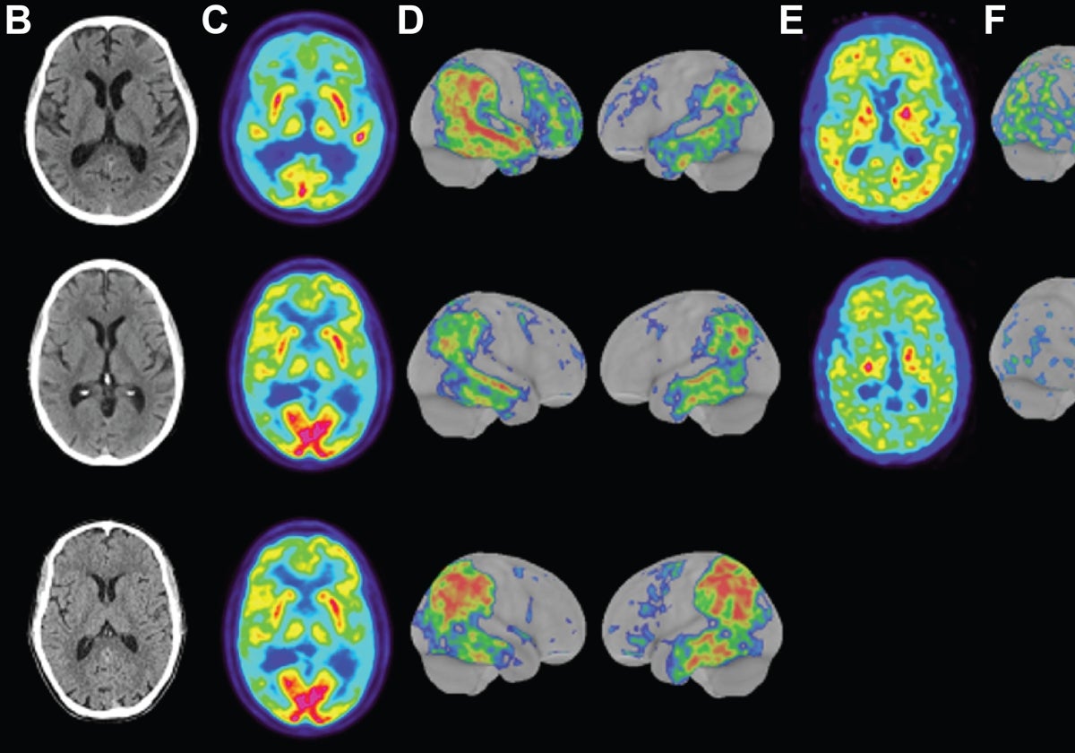 Imágenes de cerebros para un estudio de alzhéimer