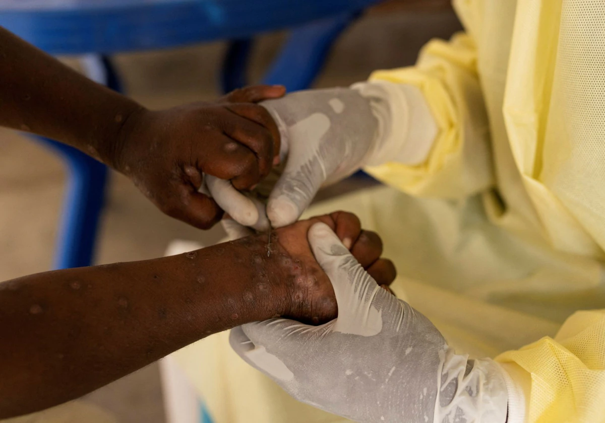 Un enfermero de laboratorio africano toma una muestra a un niño declarado caso sospechoso de Mpox