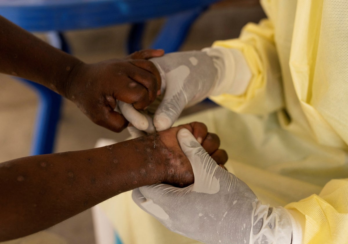 Un sanitario del Congo examina las heridas de una persona contagiada con la viruela del mono