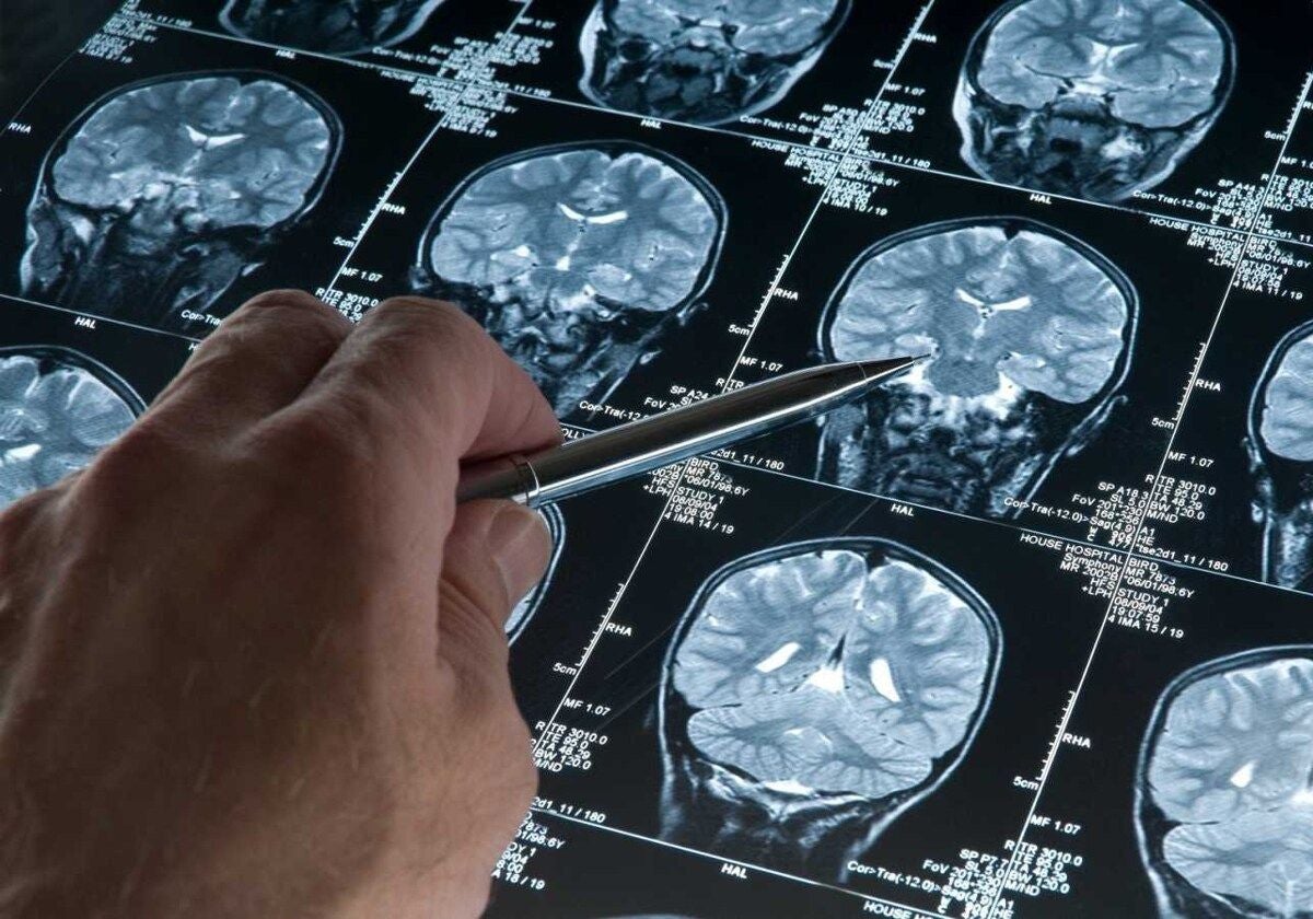 Imagen de diagnóstico de un tumor cerebral