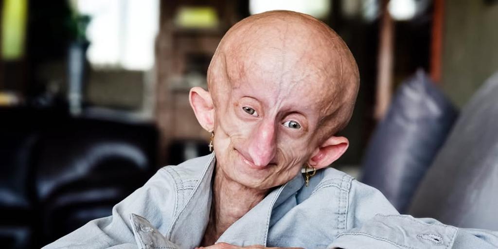 South African Influencer Beandri Booysen Dies at 19 From Progeria - News Directory 3