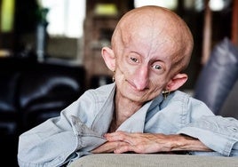 Muere a los 19 años la influencer Beandri Booysen, enferma de progeria