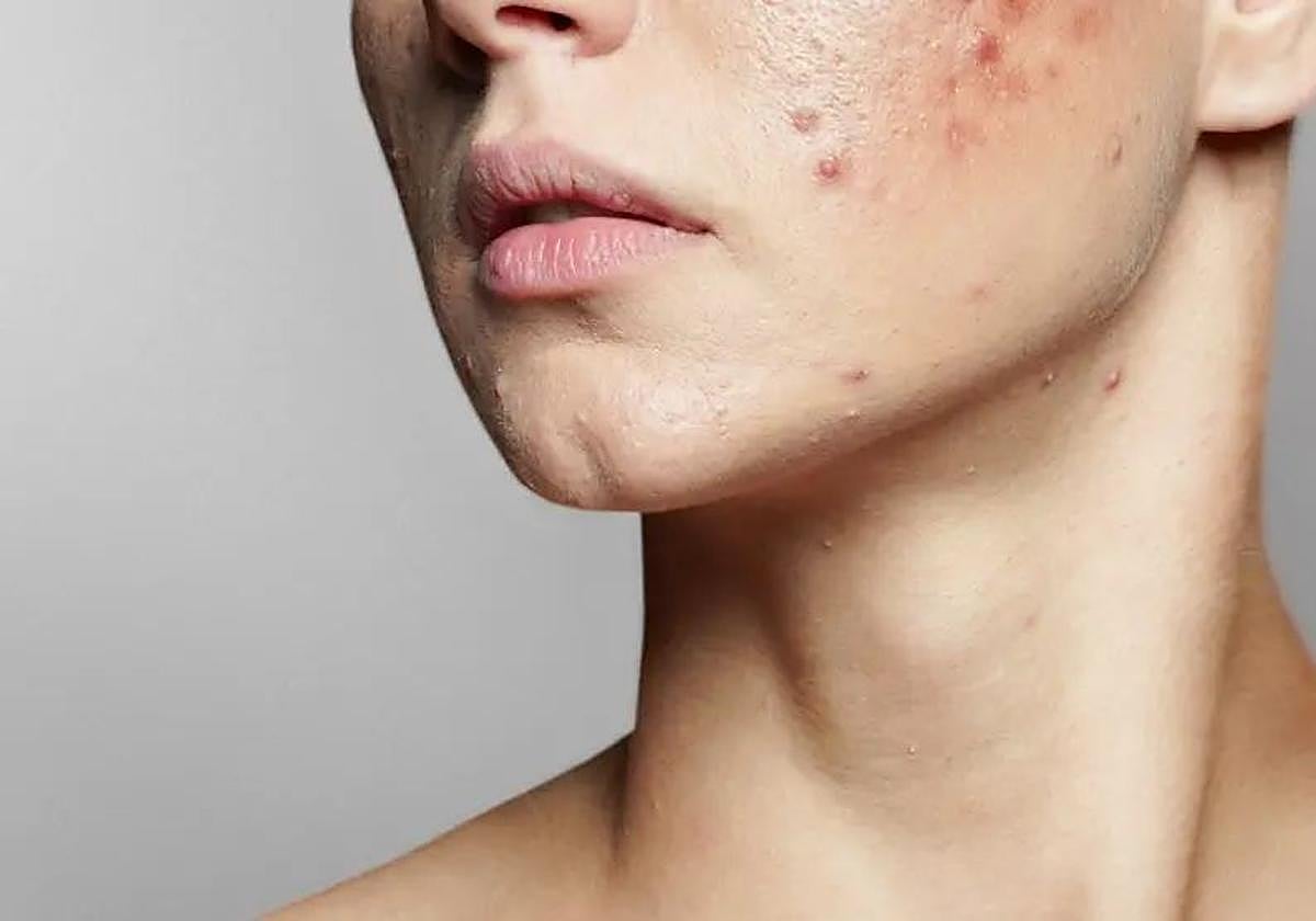 L&#039;Oreal se ve obligada a retirar un producto para el acné en EE.UU. por contener una «sustancia cancerígena»