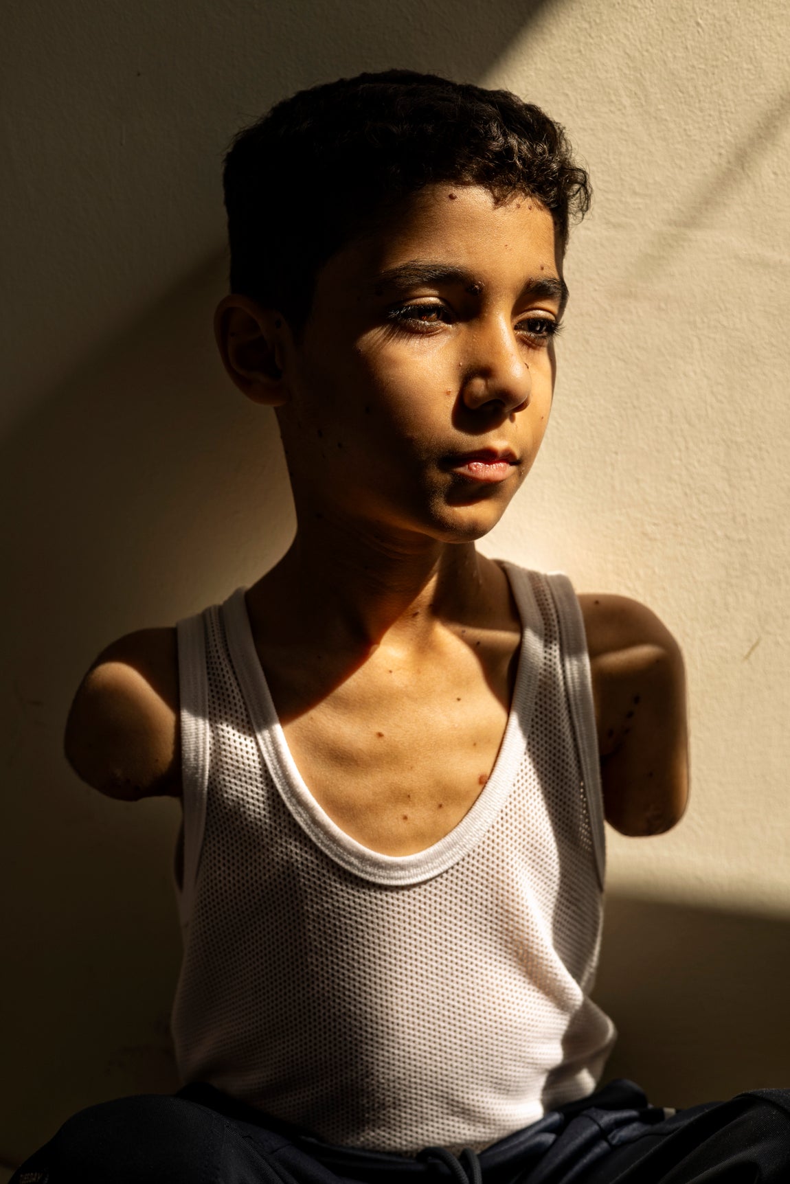 Mahmoud Ajjour, de 9 años, herido durante un ataque israelí contra la ciudad de Gaza en marzo de 2024