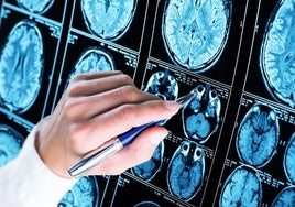 Primer ensayo en Europa para evaluar el beneficio de la cirugía que mejora la clínica del alzhéimer
