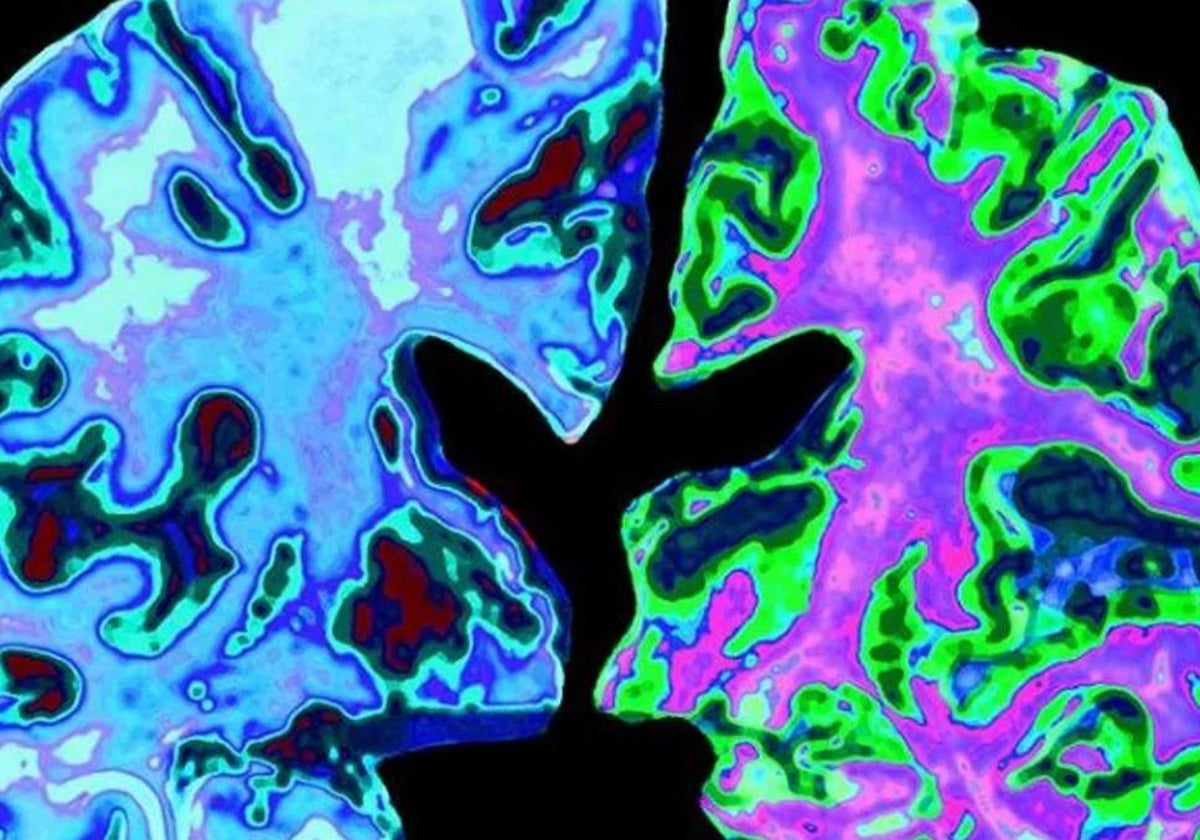 Un cerebro normal de una persona de 70 años (izquierda), comparado con el cerebro de una persona de 70 años con enfermedad de Alzheimer.