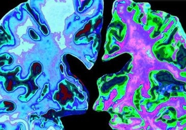 Una analítica de sangre permite conocer la progresión del alzhéimer