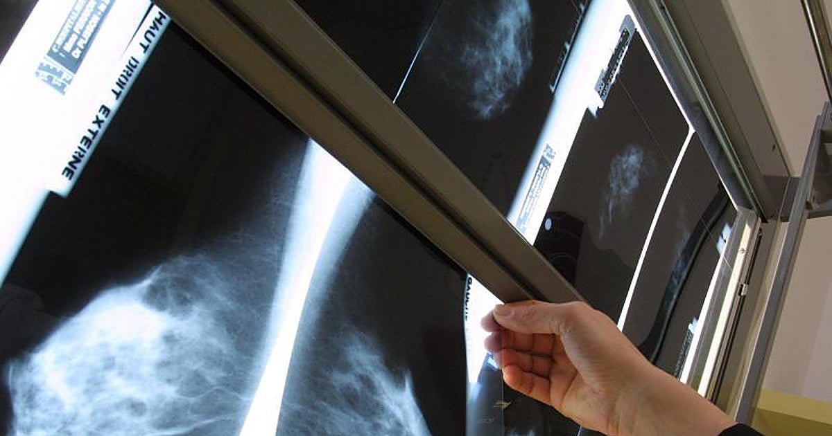 Sanidad aprueba la ampliación del cribado de cáncer de mama a mujeres de entre 45 y 74 años