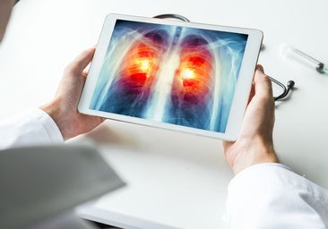¿Qué es un nódulo pulmonar? La lesión por la que operan al Papa y es frecuente entre fumadores