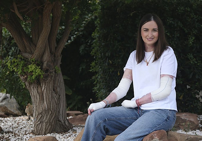 Patricia Lupión, paciente con piel de mariposa que desde hace unos meses tiene acceso a la terapia