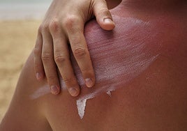 Cinco errores habituales al usar la crema solar que podrían provocar quemaduras en la piel