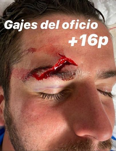 El portero del Villarrubia recibió 16 puntos de sutura tras golpearse con el palo