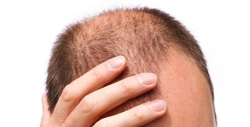 Las cuatro causas de la alopecia