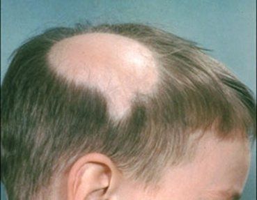 Las cuatro causas de la alopecia