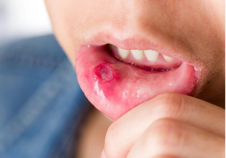 Qué es la enfermedad del boca-mano-pie en los niños, cuáles son los síntomas y cómo puedes tratarlo