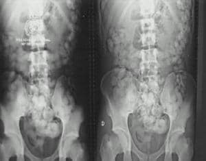 EFE  Las radiografías muestran la droga que los «boleros» se habían introducido en el cuerpo