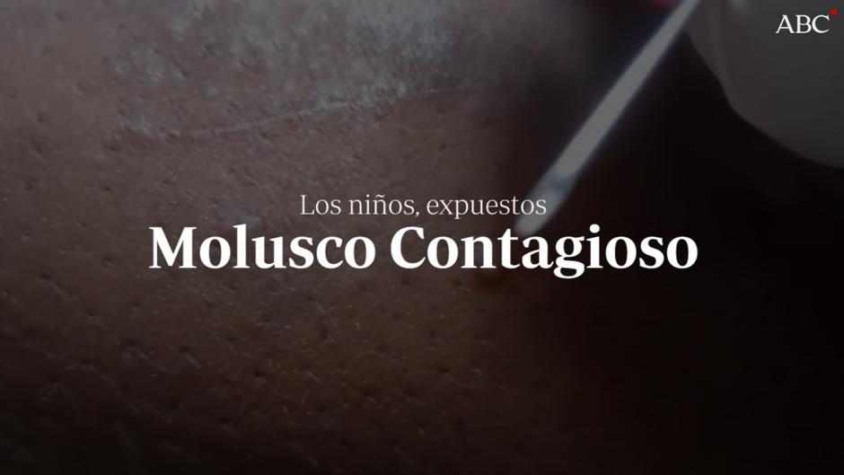 El molusco contagioso, una enfermedad al alcance de los niños