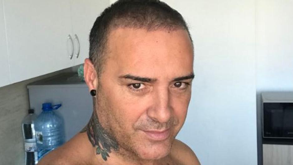 Dinio, el útlimo famosos en recurrir a los injertos de pelo