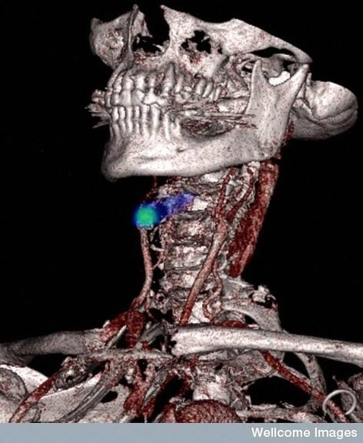 Detección de un infarto. 