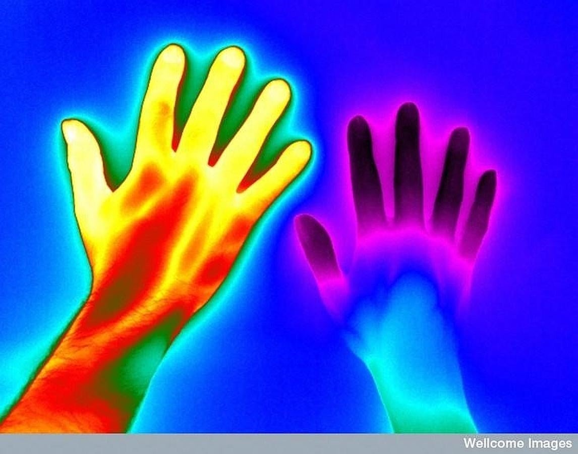 Efectos de la enfermedad Raynaud. 