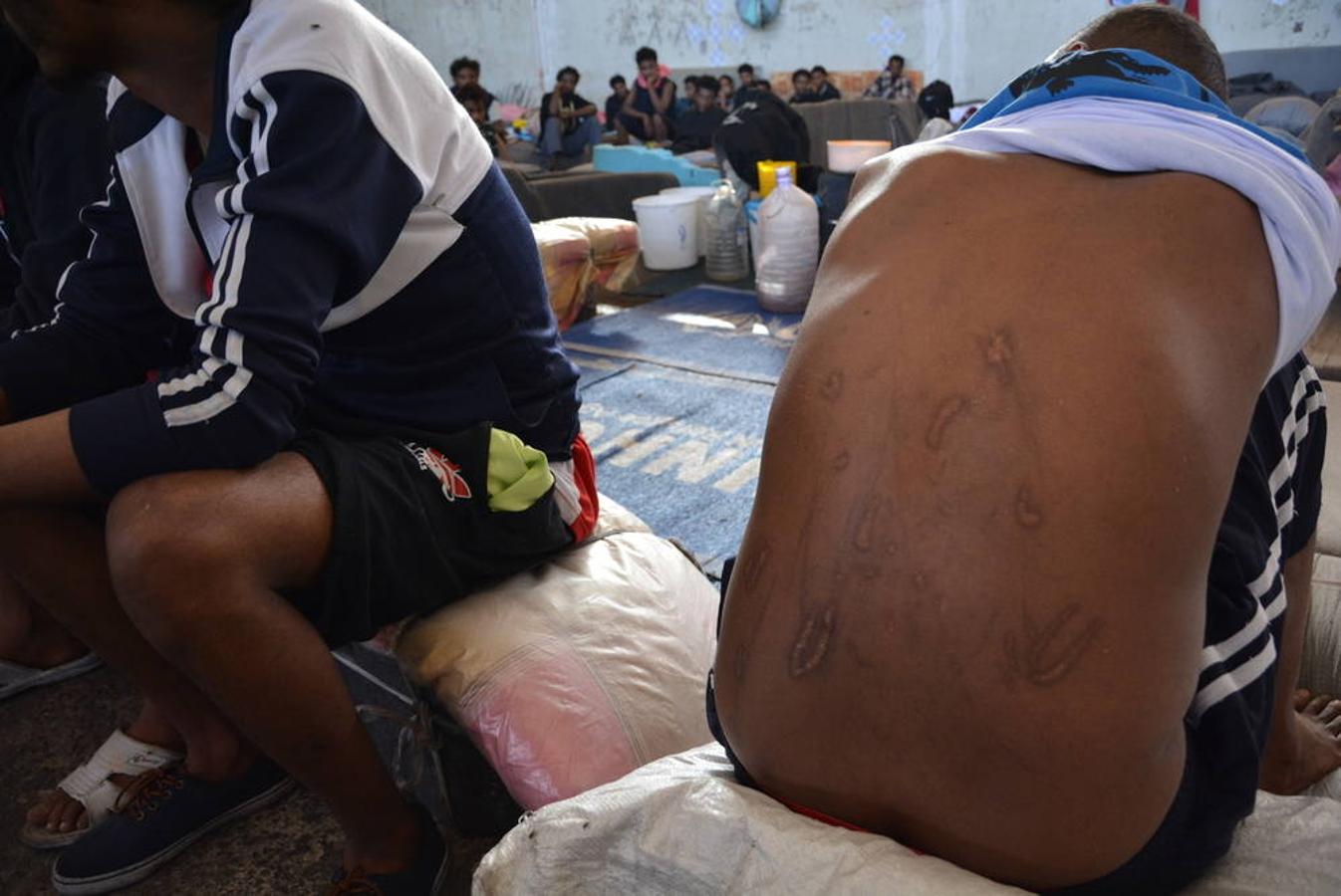 Un migrante muestra a la cámara sus  cicatrices y heridas durante su cautiverio a manos de traficantes.La mayoría ya ha pasado por experiencias terribles en Libia antes de ser trasladados a un centro de detención. Fueron secuestrados por traficantes de personas que los sometieron a violaciones y torturas.. 