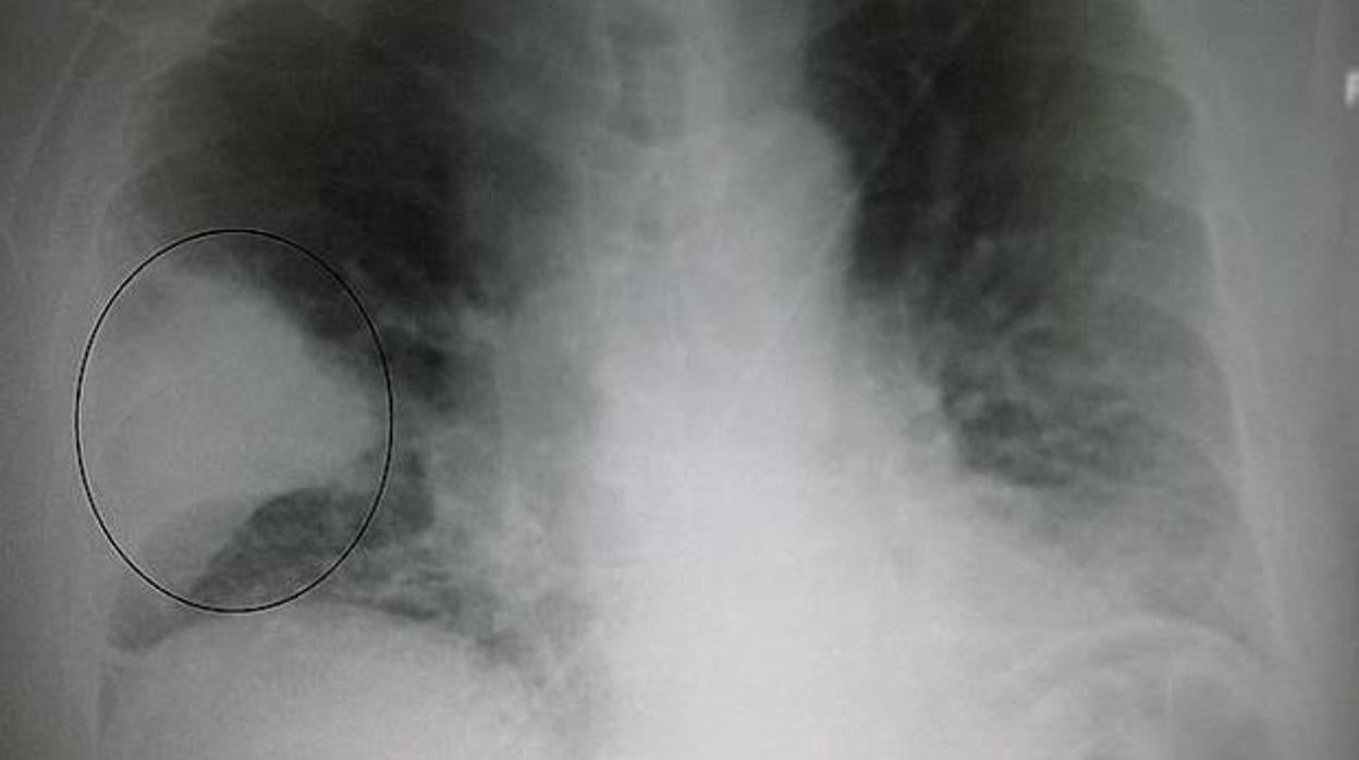 La fibrosis quística causa una acumulación de mucosidad en los pulmones