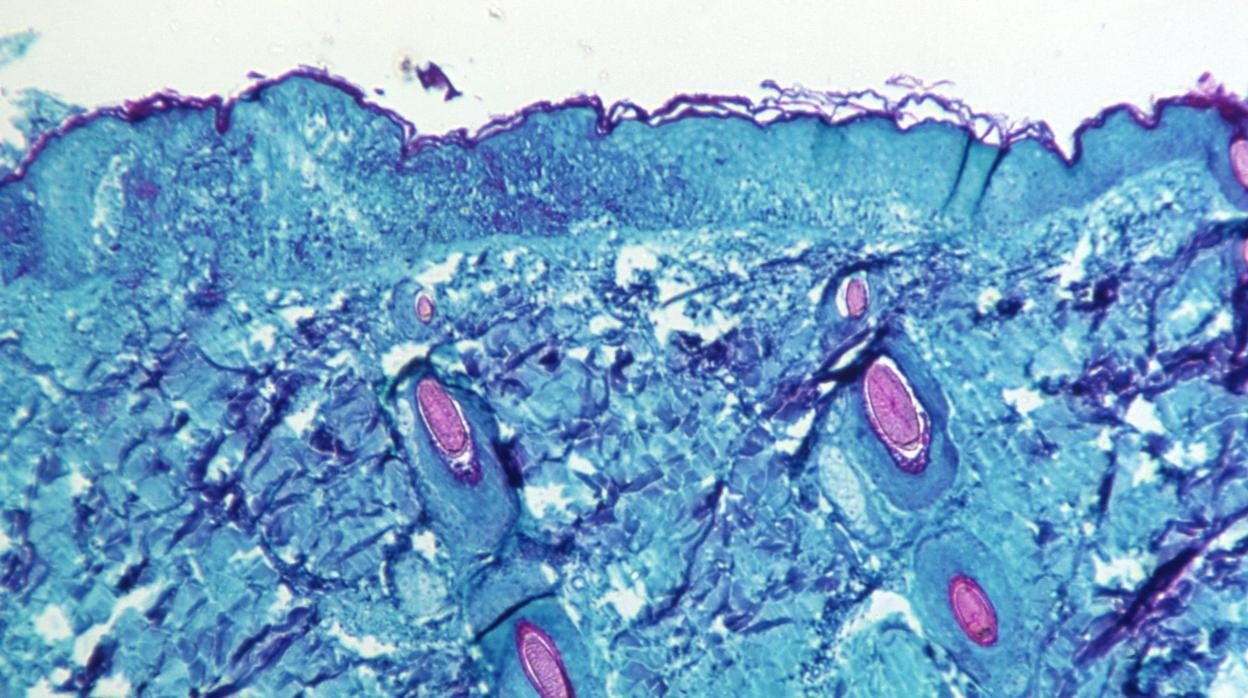 Una sección de tejido de la piel, extraída de una lesión en la piel de un mono, que había sido infectado con el virus de la viruela del simio