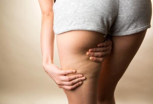 Cómo prevenir la celulitis.