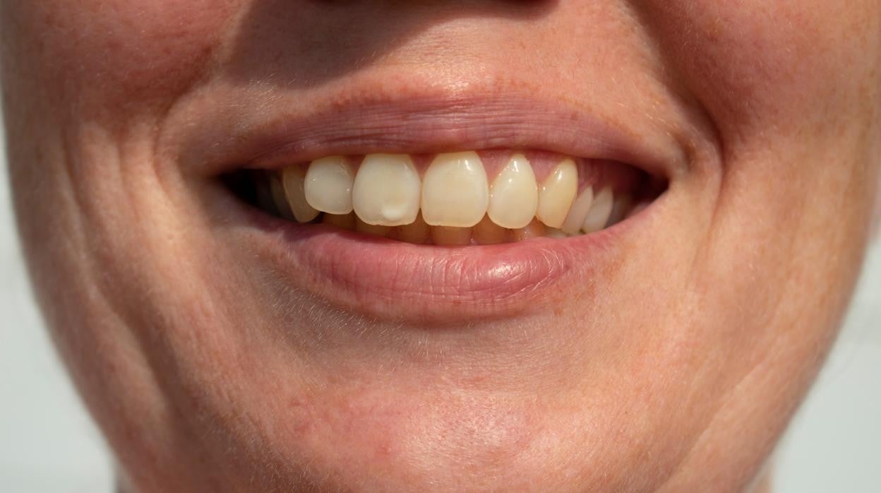 Qué son las manchas blancas de los dientes.