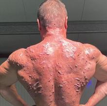 Una reacción extrema al uso de esteroides