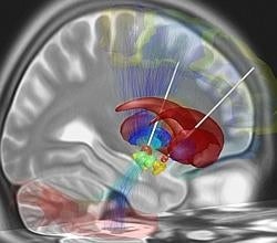 Implantes de electrodos localizados en el núcleo subtalámico de personas con la enfermedad de Parkinson