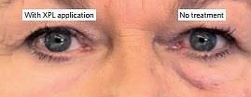 A la izquierda, un ojo tratado y recubierto con la piel de silicona que ha hecho desaparecer la bolsa y a la derecha el ojo con sus bolsas naturales, sin disimular