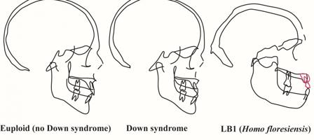 Perfiles de cráneos en personas con y sin síndrome de Down