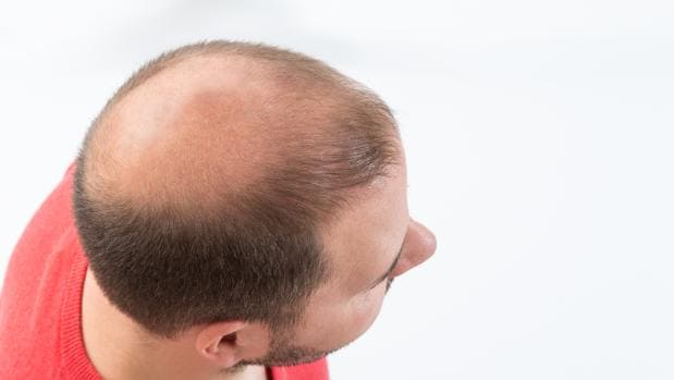 Los investigadores no han podido hacer una fórmula que permita decirle a un individuo qué riesgo tiene de quedarse calvo, pero sí identificar grupos de población donde es más probable que aparezca la alopecia