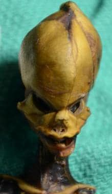 El cráneo cónico de la momia