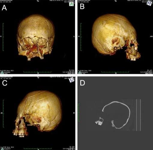 Tomografías del cráneo tipo erecto en el que se pueden observar unas marcas producidas pribablemente por una suerte de «visera» circular que buscaría realzar el centro.