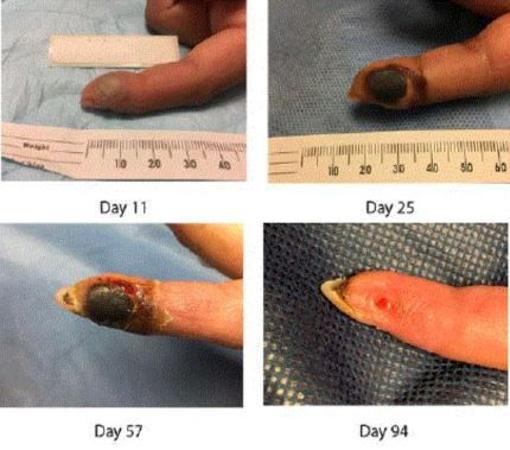 Evolución de la herida después de la infección. Las lesiones tardaron tres meses en curarse