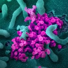 Fotografía coloreada de varios virus adheridos a una célula y vistos al microscopio electrónico